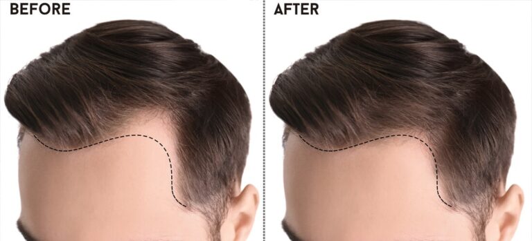 Best Hair Transplant in Islamabad: Your Ultimate Guide to Achieving Natural Hair Restoration